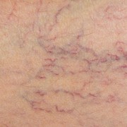 qué son las varices qué son las varices