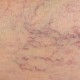 qué son las varices