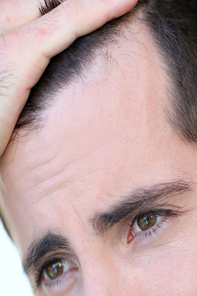 alopecia alopecia
