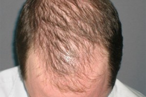tratamiento alopecia
