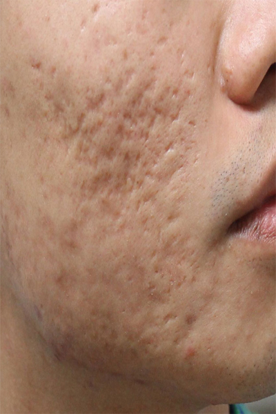 cicatrices acne cicatrices acne