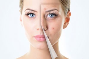https://www.sinvarices.es/cicatrices-acne/