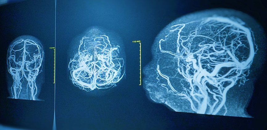 Angiografía cerebral en varias proyecciones