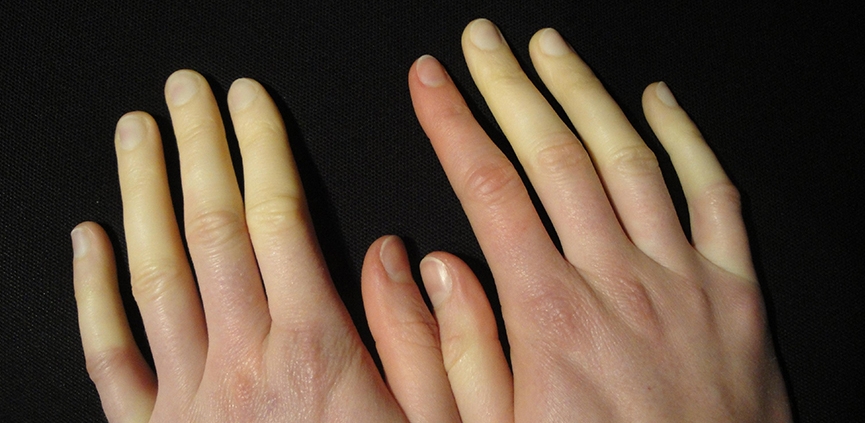 Manos con los dedos pálidos por síndrome de Raynaud