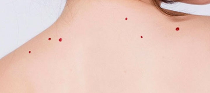 Puntos de rubí o angiomas planos