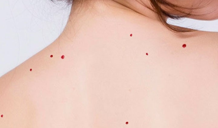 Puntos de rubí o angiomas planos