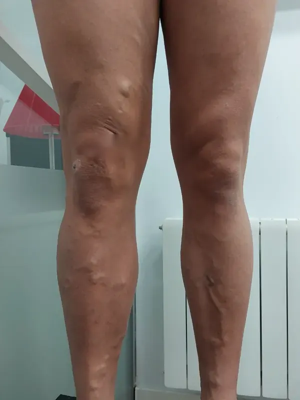 Piernas con varices antes del tratamiento en SinVarix Clinic