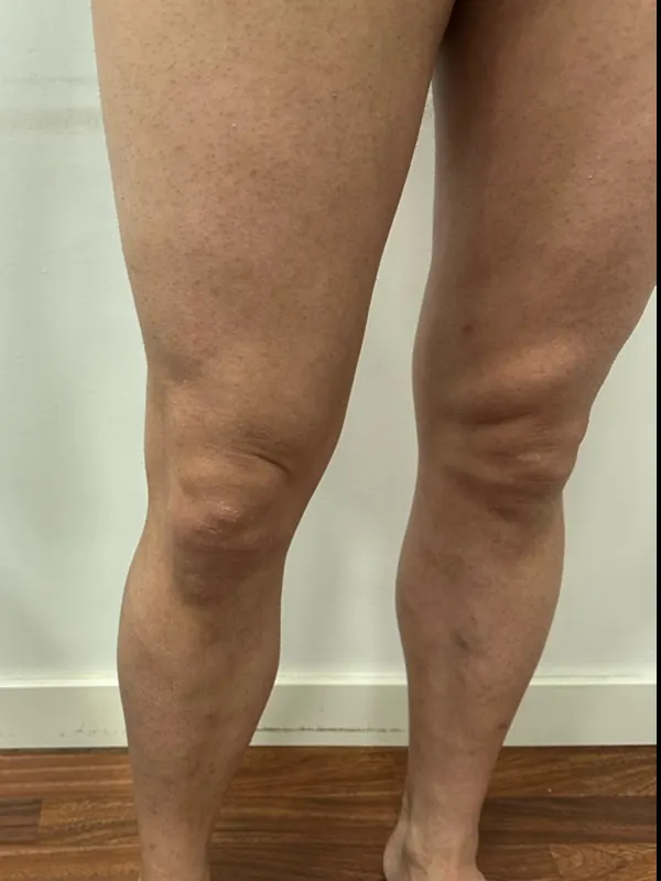 Las mismas piernas después del tratamiento