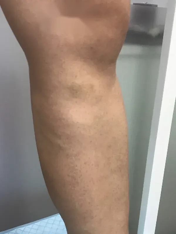 Caso SinVarix 16: piernas después del tratamiento