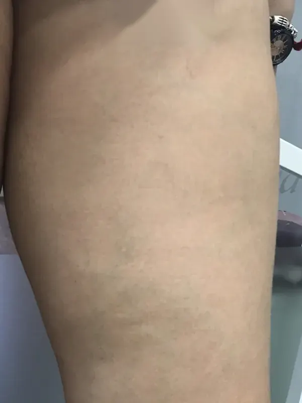Caso SinVarix 17: piernas después del tratamiento