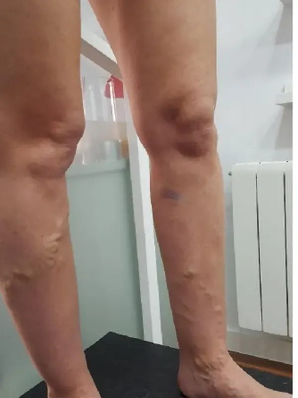 Caso SinVarix 18: piernas antes del tratamiento