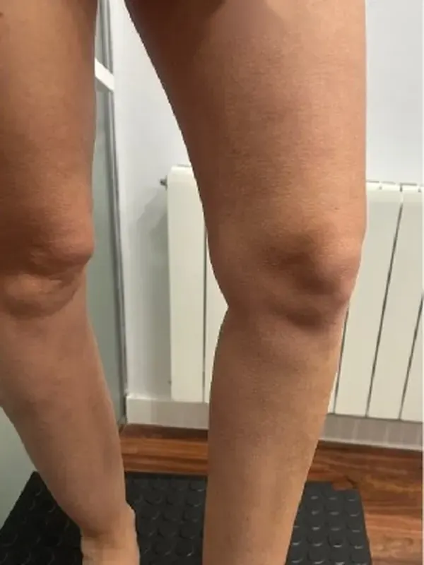 Caso SinVarix 18: piernas después del tratamiento