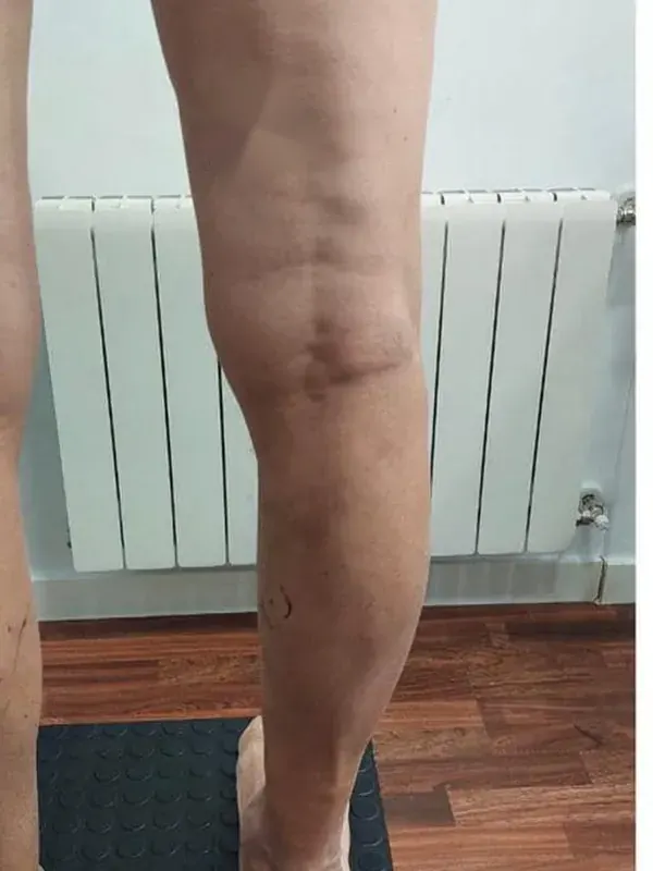 Caso SinVarix 19: piernas después del tratamiento