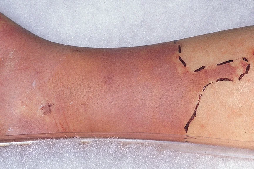 Pierna con alteraciones de la piel por falta de riego arterial