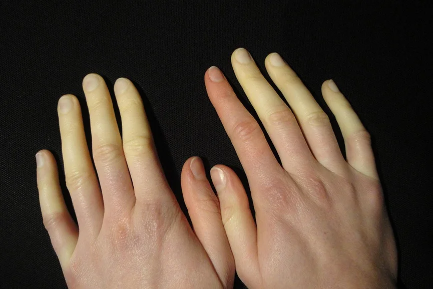 Dedos blancos por el síndrome de Raynaud