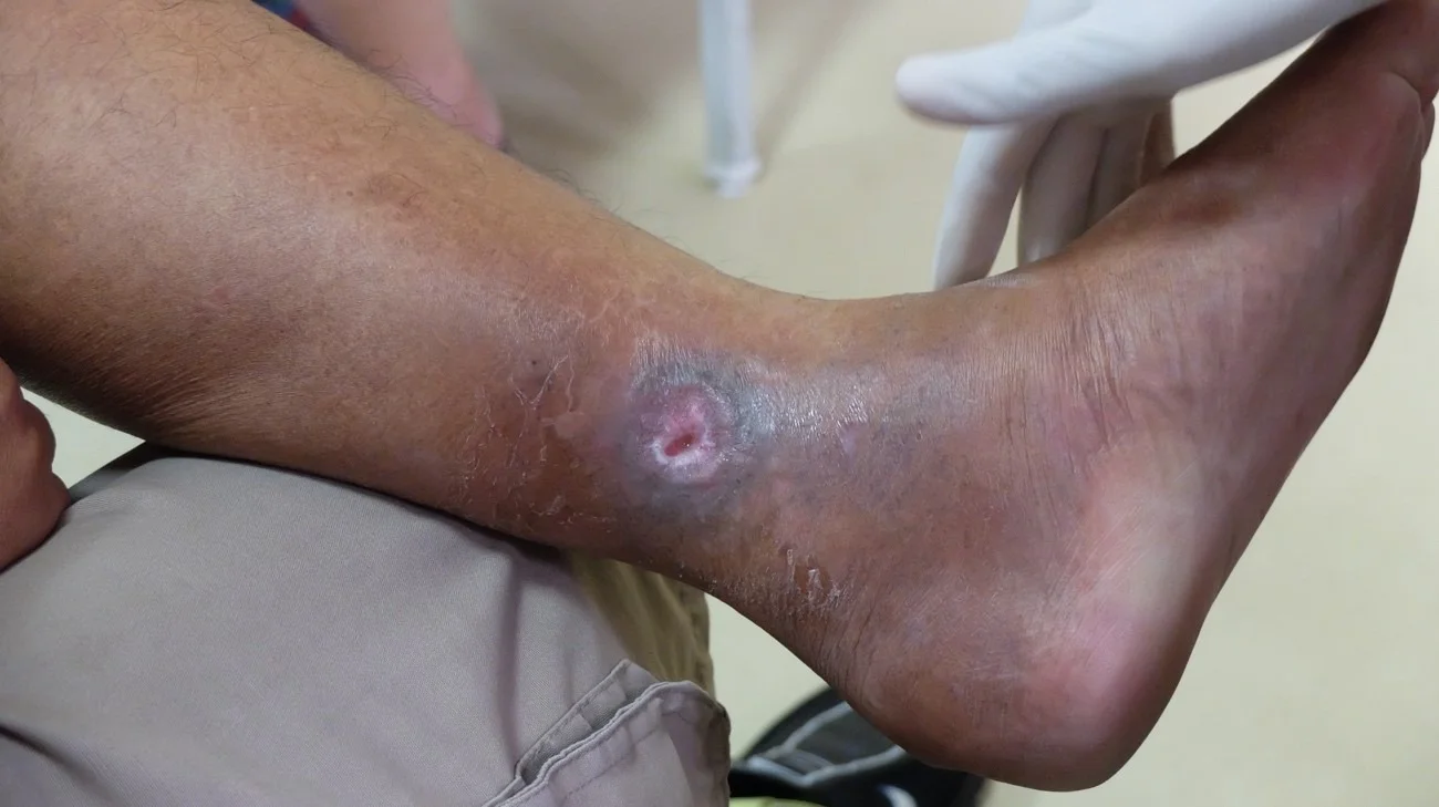 Úlcera vascular en el tobillo