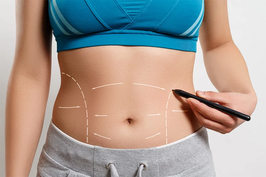Abdomen marcado para un tratamiento de remodelación corporal