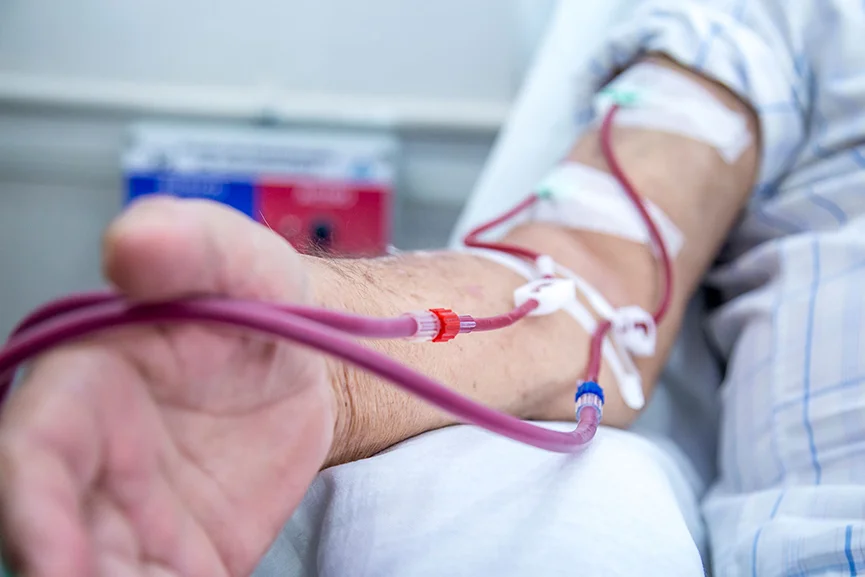Paciente en hemodiálisis conectado por un acceso vascular del brazo