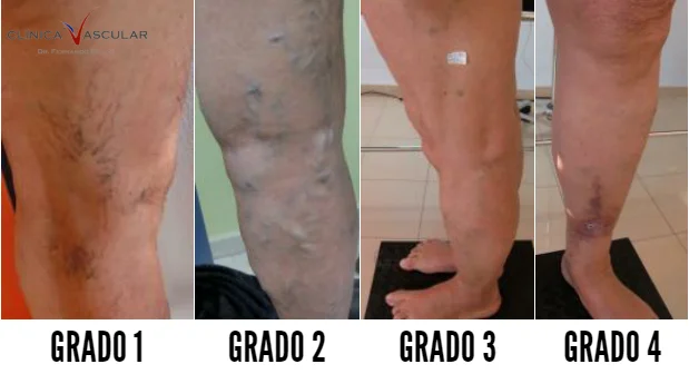 Varices en las piernas de grado 1 a grado 4