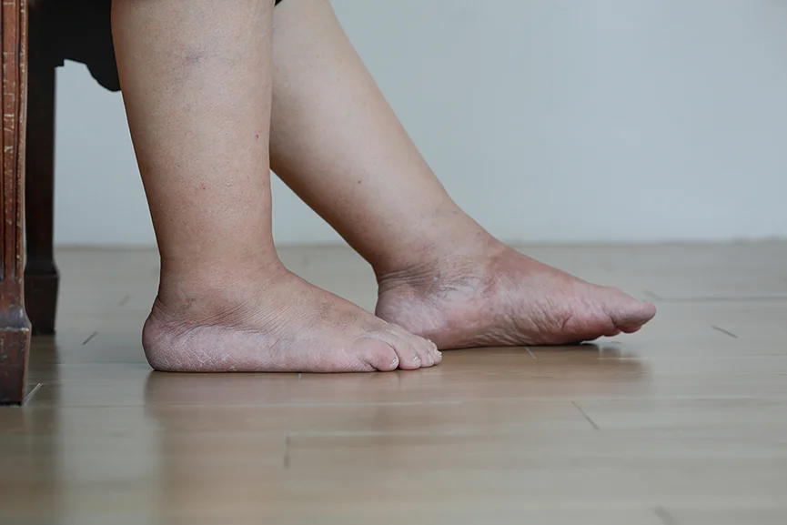 Pies y tobillos con alteraciones de la piel