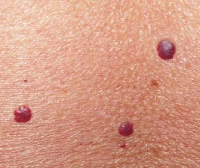 Detalle de varios puntos rubí en la piel