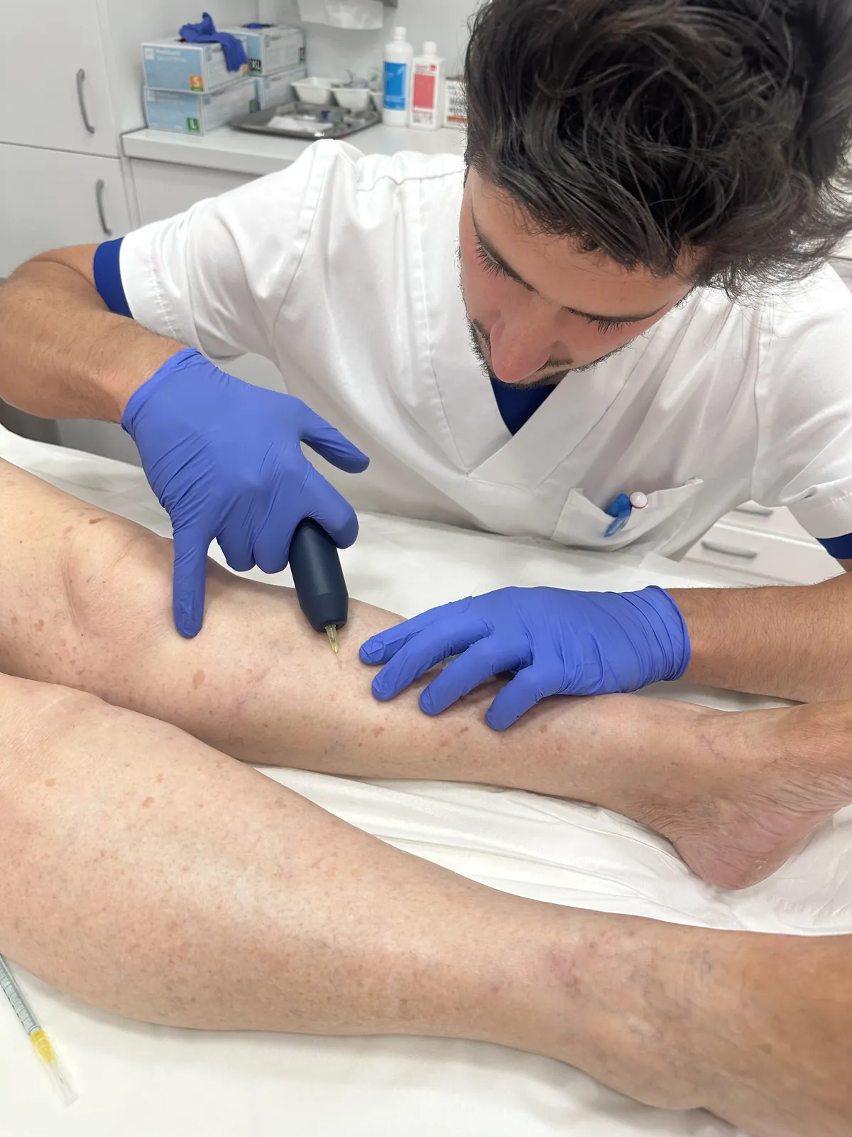 Tratamiento de crioesclerosis en la consulta