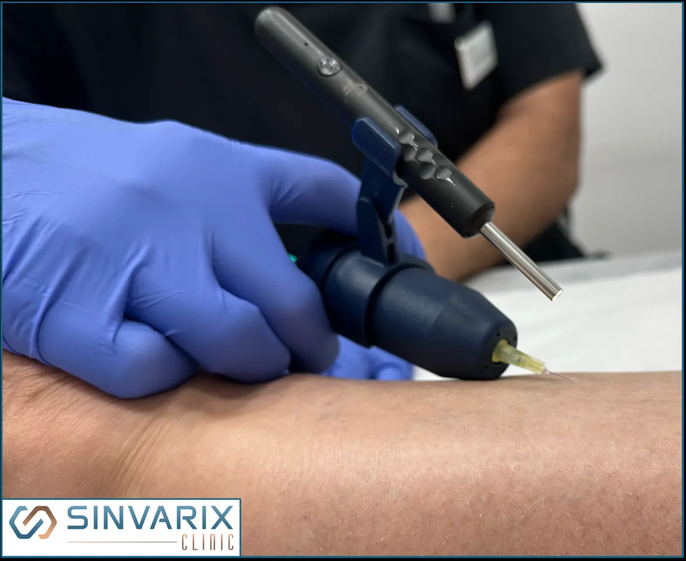Aplicación de crioesclerosis en la pierna en SinVarix Clinic