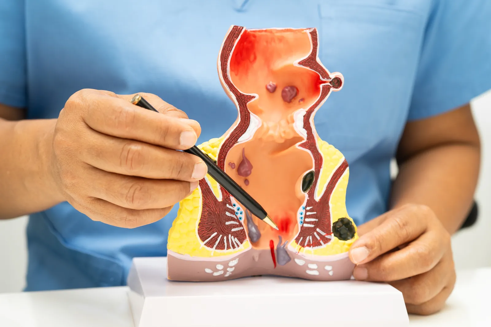 Médico explicando las hemorroides con una maqueta anatómica