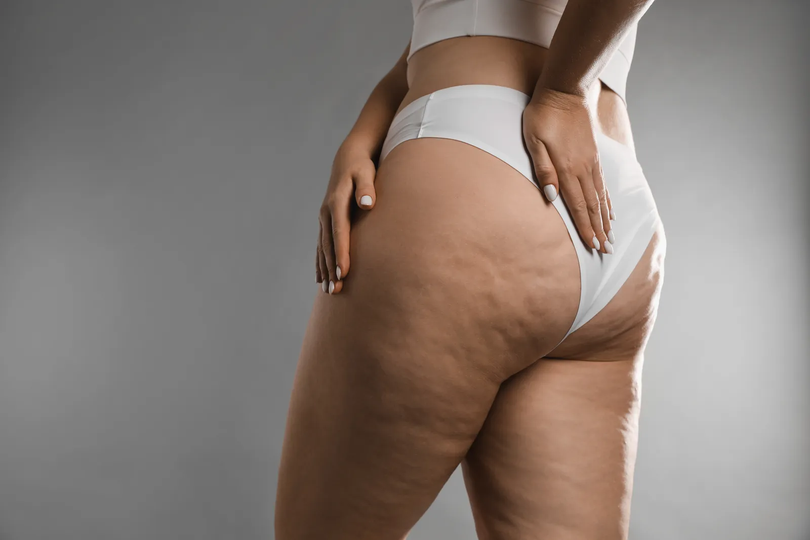 Acumulación de grasa en muslos y caderas, característica del lipedema