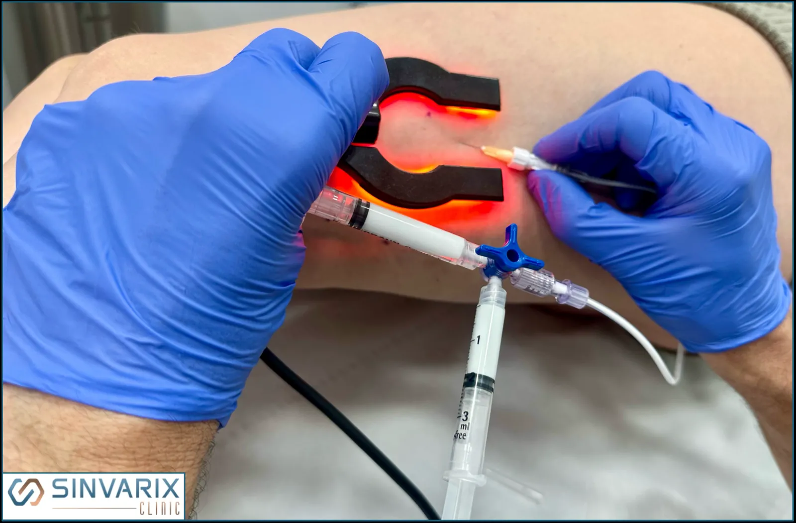 Aplicación de microespuma en una variz con transiluminación