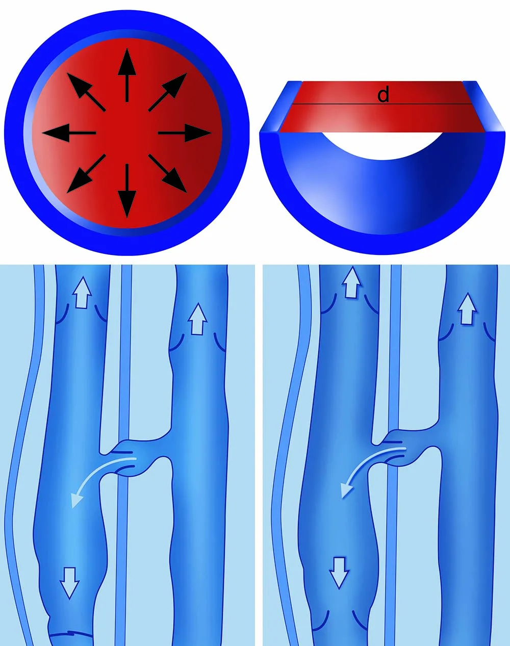 Esquema del enfoque hemodinámico de la fleboterapia TRAP sobre la pared y el flujo venoso